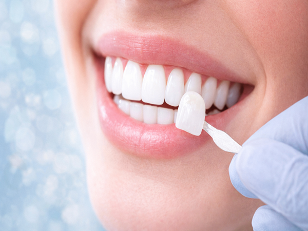 Veneers